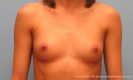 Philadelphia Breast Augmentation 9421 - Before Image 1