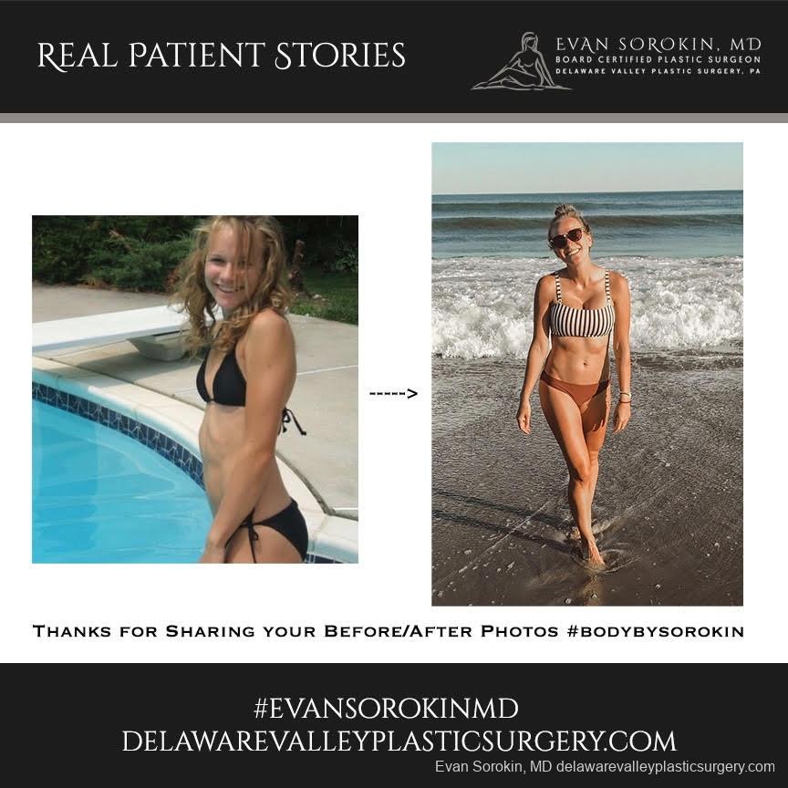 Real Patient Stories: Patient 5 - Before and After Image 1