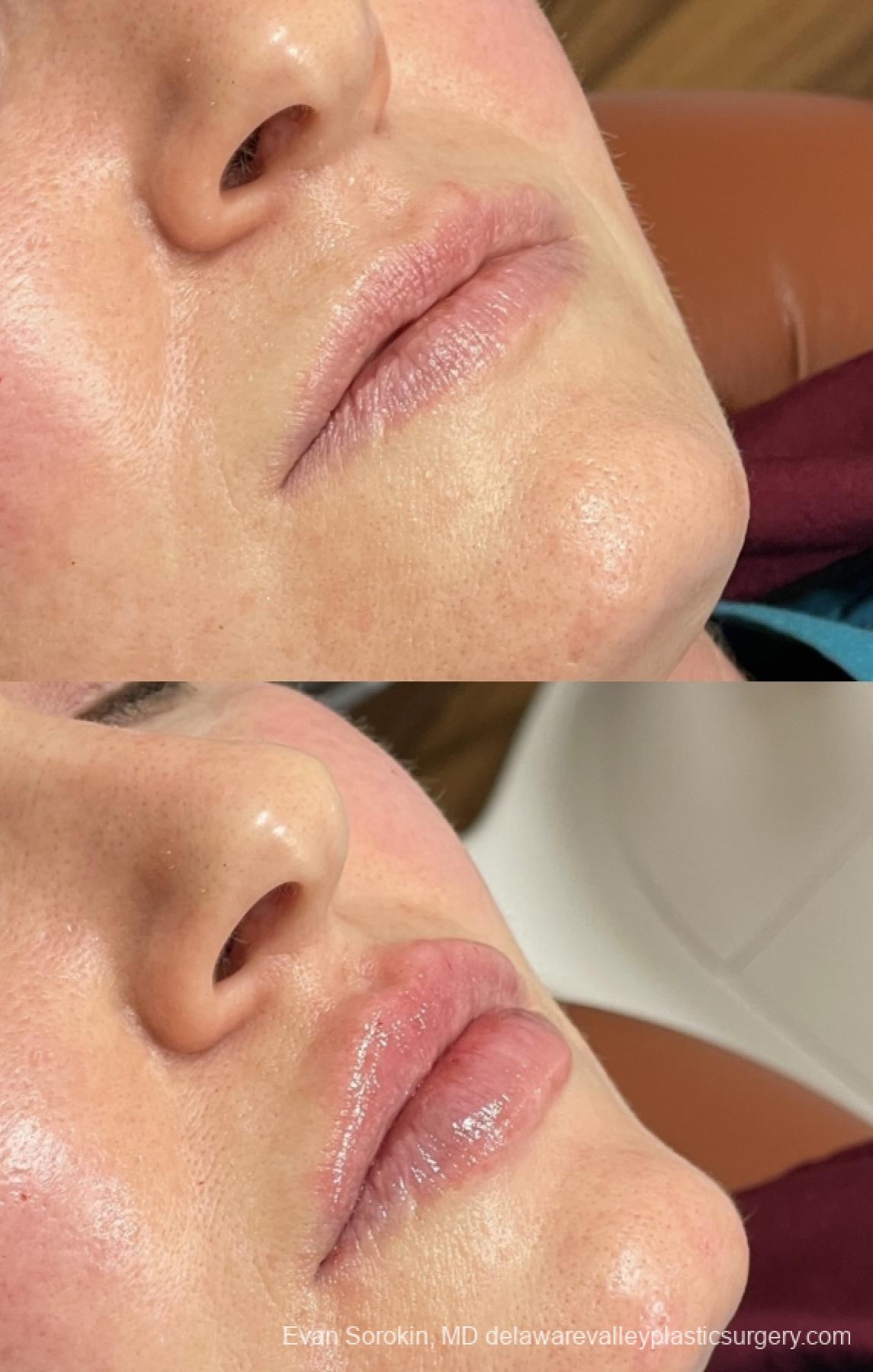Lip Filler: Patient 47 - Before and After 2