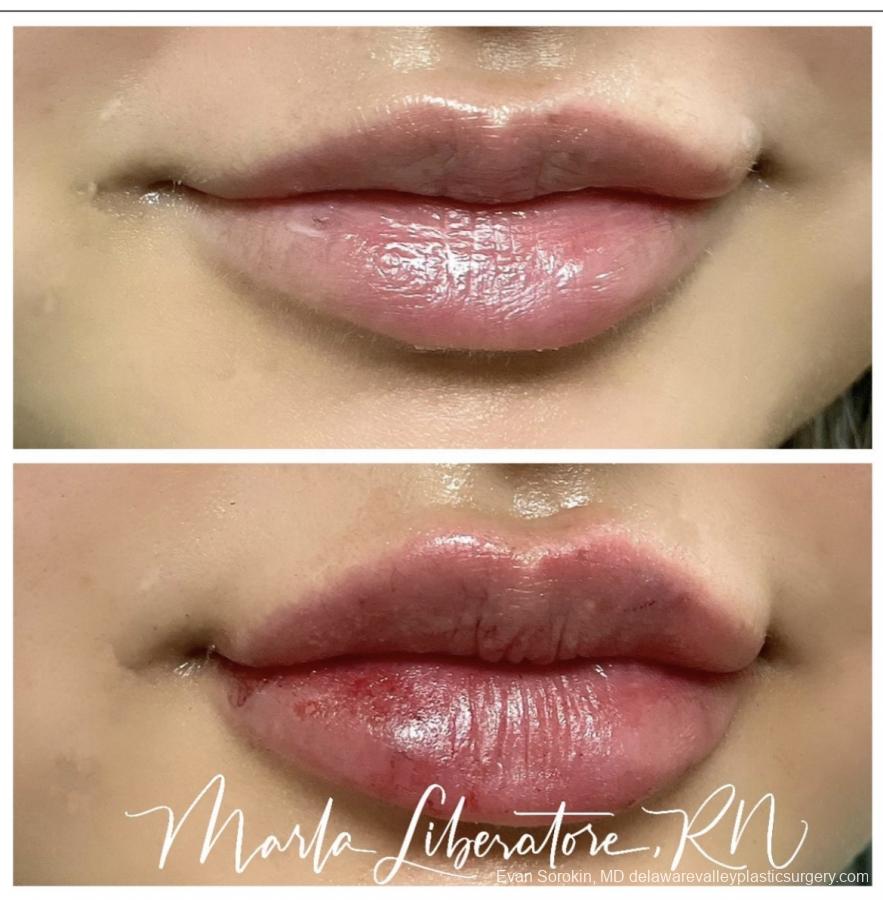 Lip Filler: Patient 17 - Before and After Image 1