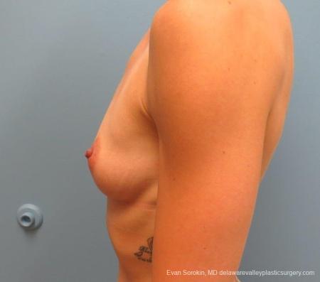 Philadelphia Breast Augmentation 8823 - Before and After Image 5