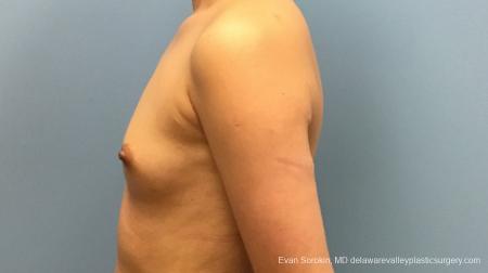 Philadelphia Breast Augmentation 13172 - Before and After Image 5