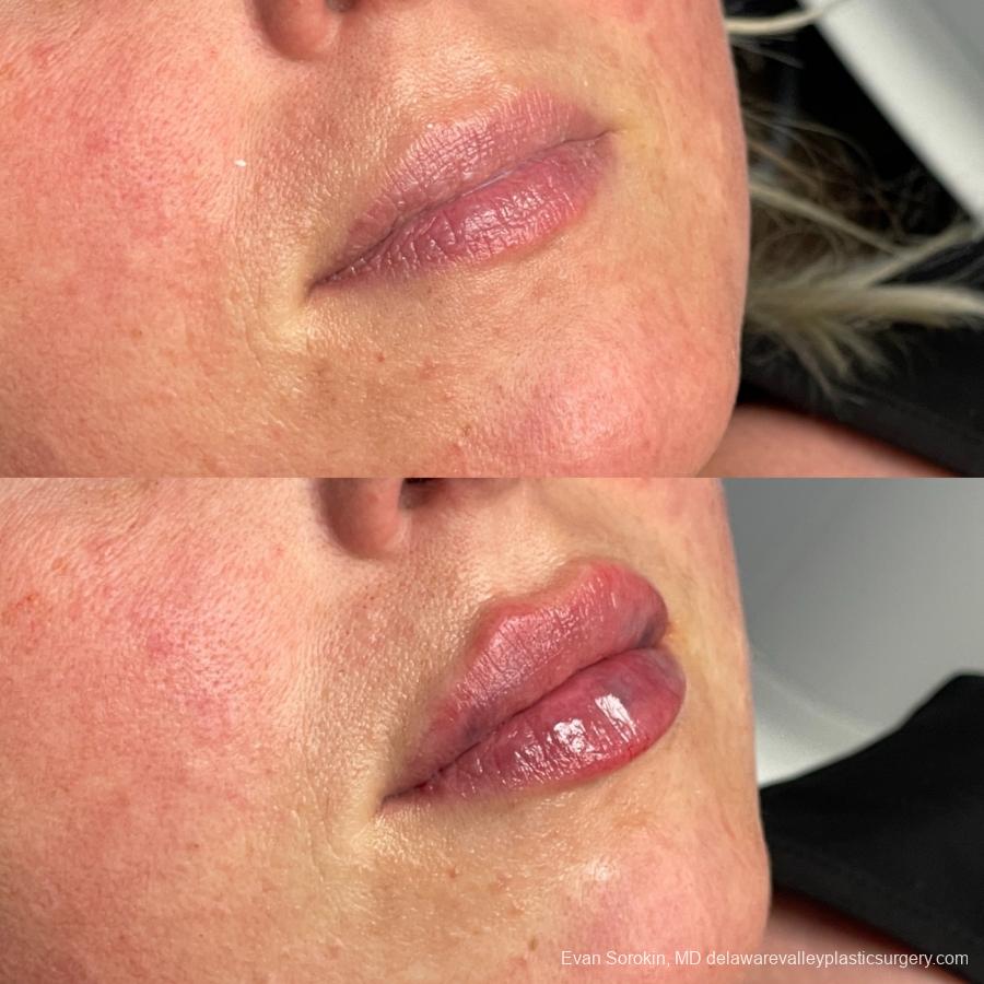 Lip Augmentation: Patient 68 - Before and After 2