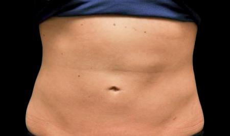 CoolSculpting®: Patient 4 - After 1