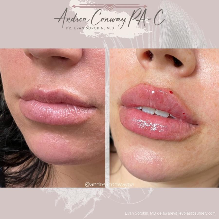 Lip Augmentation: Patient 24 - Before and After 2