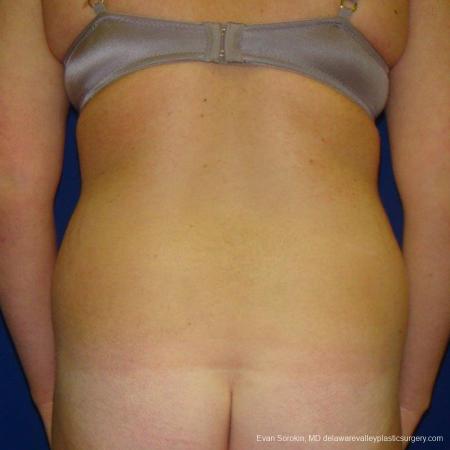 Philadelphia Liposuction 9484 - Before and After Image 5