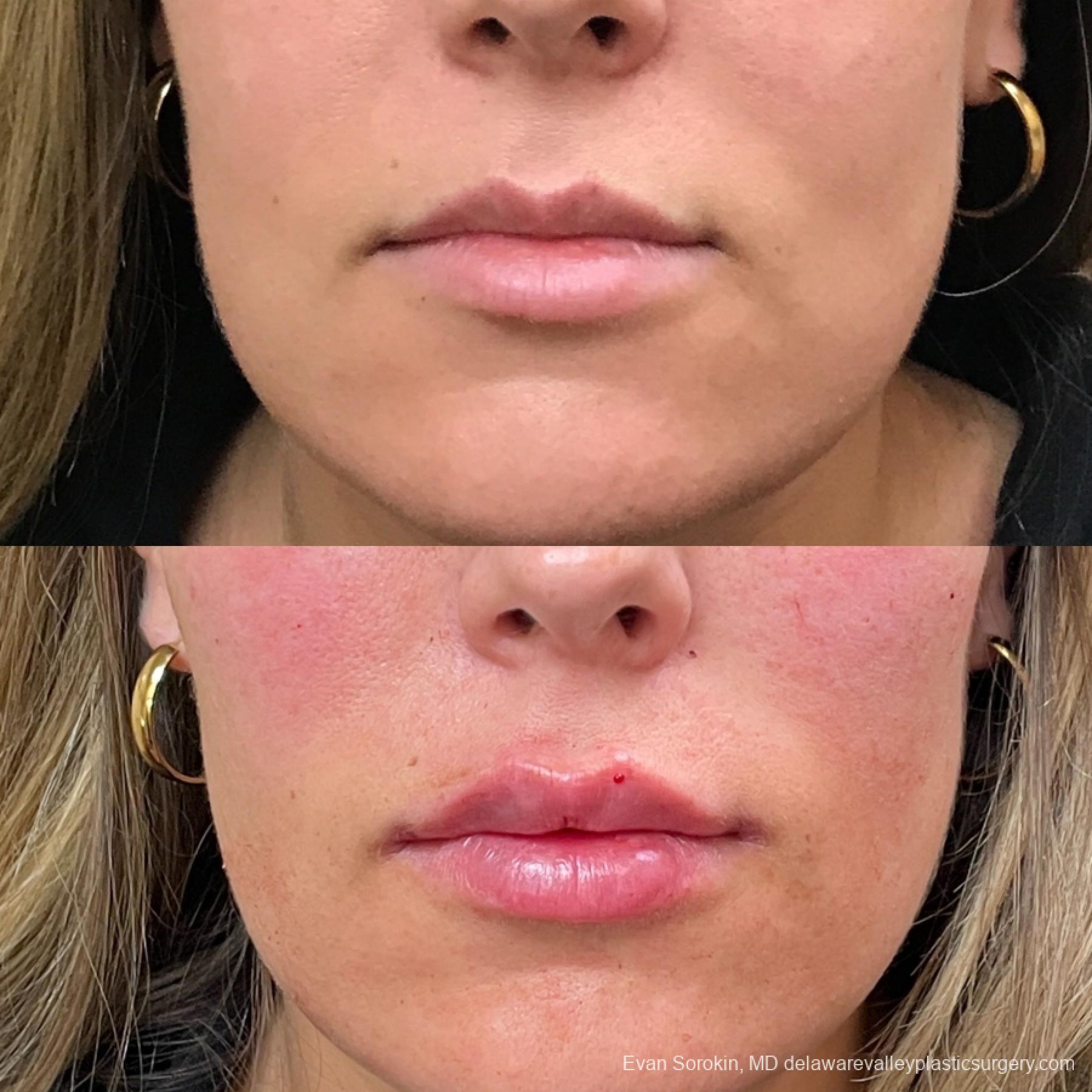 Lip Filler: Patient 37 - Before and After 1