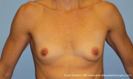 Philadelphia Breast Augmentation 10248 - Before Image 1