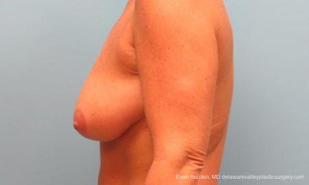 Philadelphia Breast Lift and Augmentation 9398 - Before and After Image 5