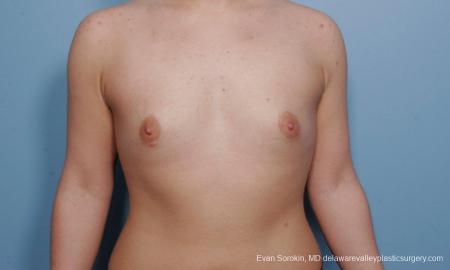 Philadelphia Breast Augmentation 9378 - Before Image 1