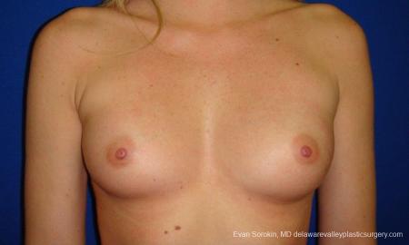 Philadelphia Breast Augmentation 9293 - Before Image 1