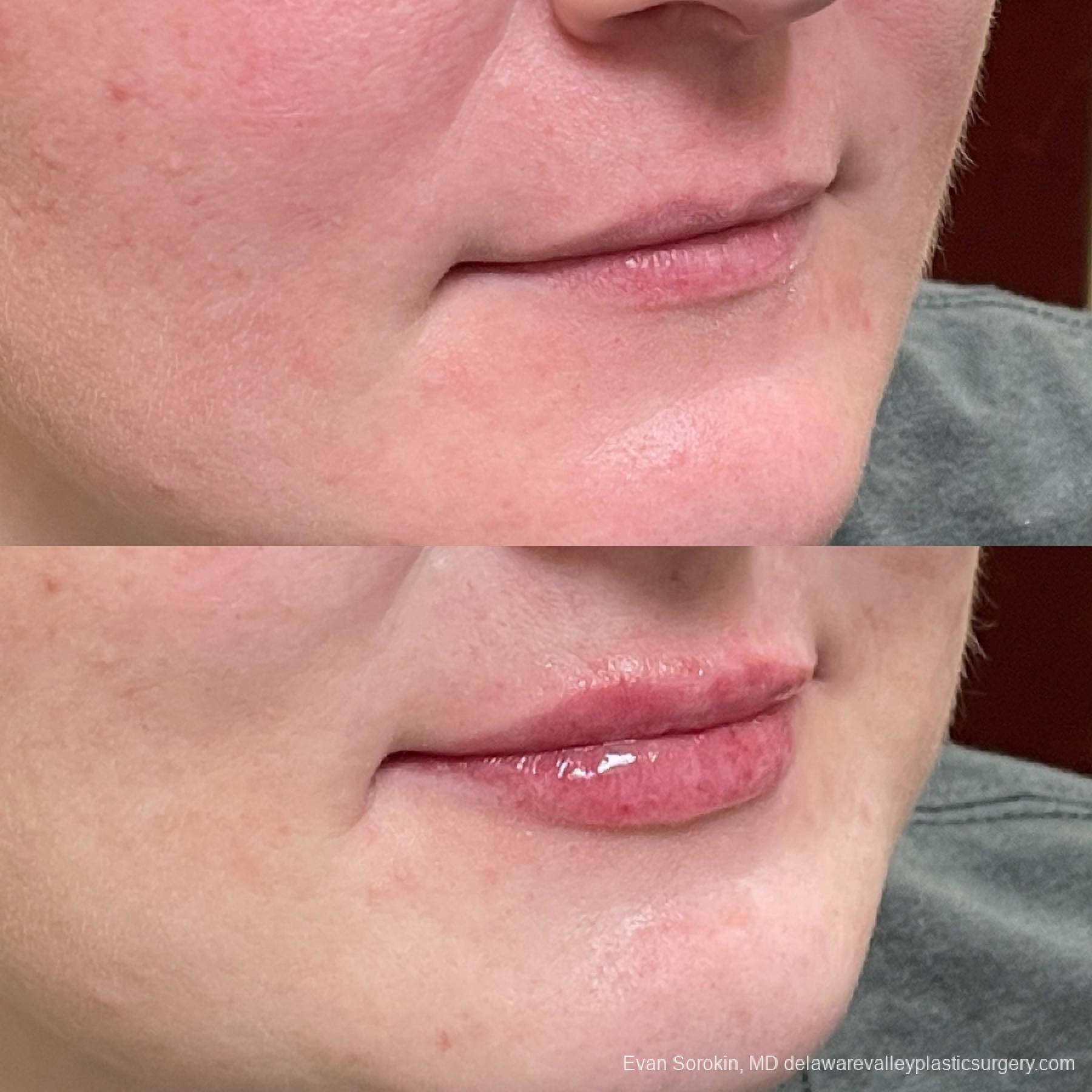 Lip Filler: Patient 11 - Before and After 2