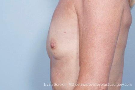 Philadelphia Breast Augmentation 8770 - Before and After Image 5