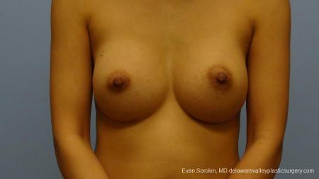 Philadelphia Breast Augmentation 9291 - After Image 1