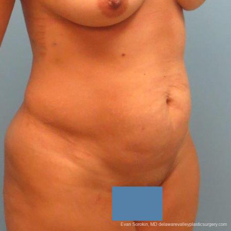 Philadelphia Abdominoplasty 9478 - Before Image 4