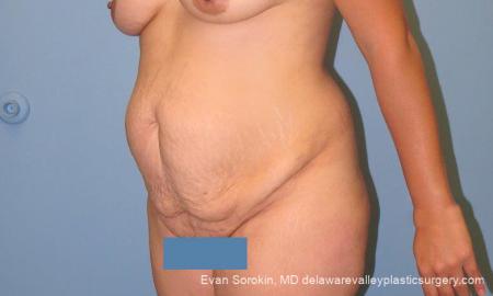 Philadelphia Abdominoplasty 10122 - Before Image 4