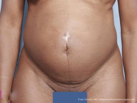 Philadelphia Abdominoplasty 9339 - Before Image 1