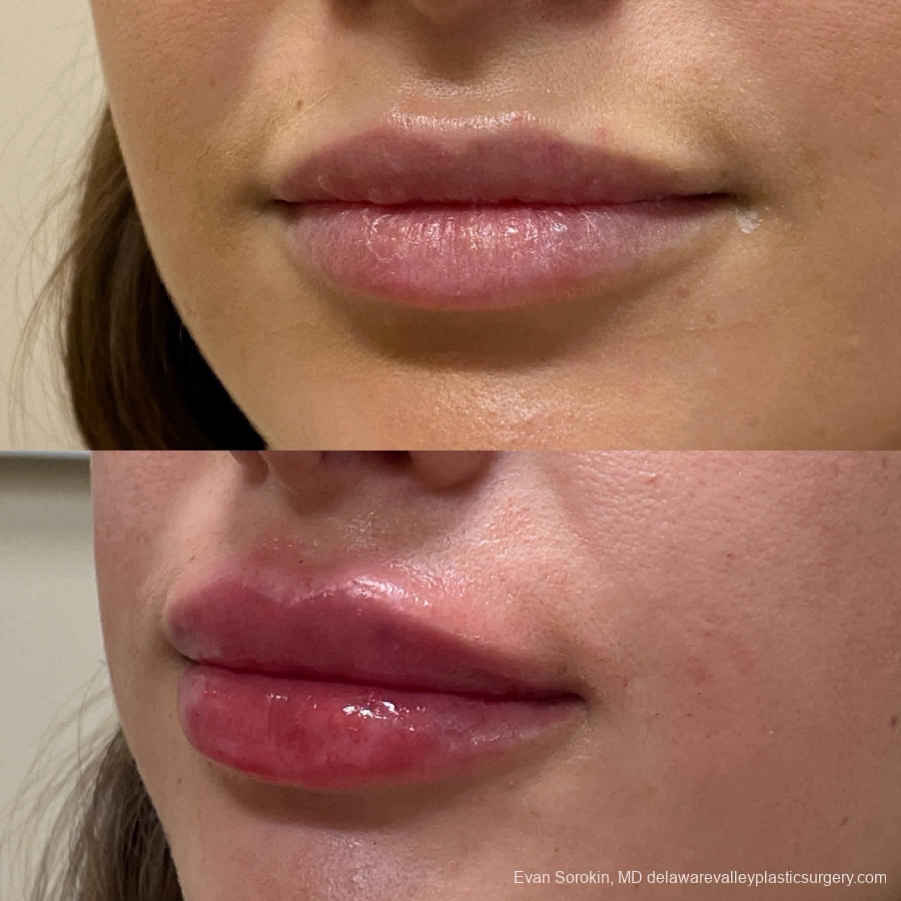 Lip Augmentation: Patient 29 - Before and After 3