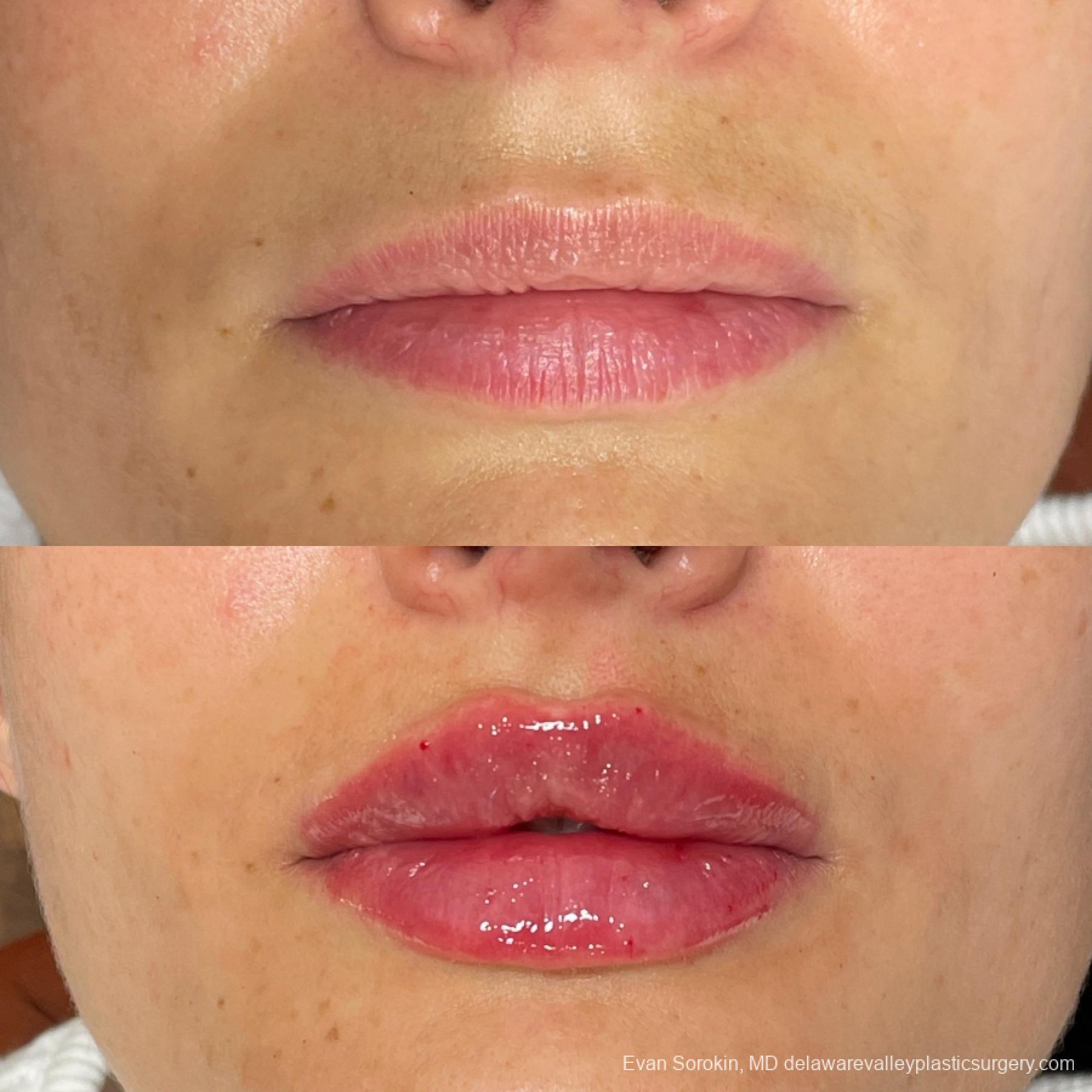 Lip Augmentation: Patient 26 - Before and After 