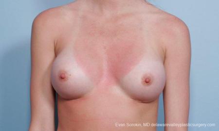 Philadelphia Breast Augmentation 8660 - After Image 1
