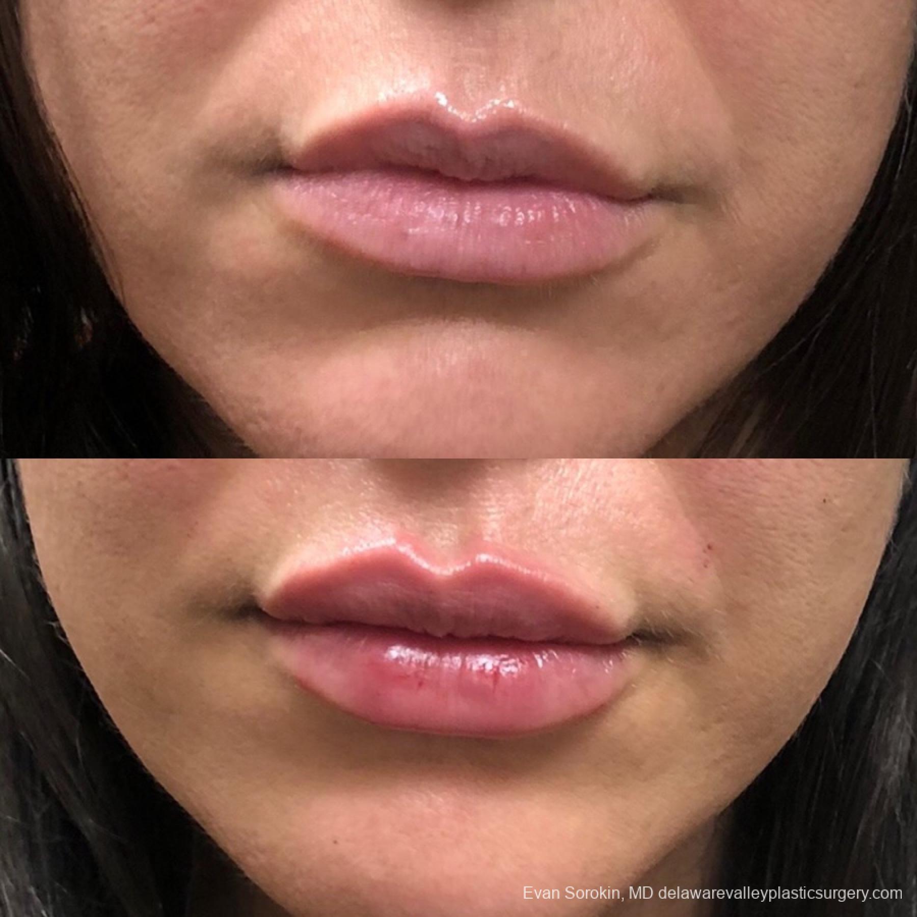 Lip Filler: Patient 16 - Before and After 