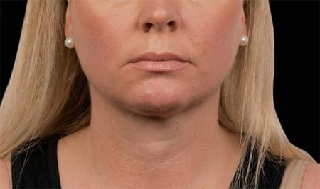 CoolSculpting®: Patient 5 - After Image 2