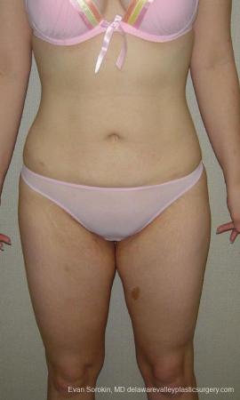 Philadelphia Liposuction 9480 - After Image 1