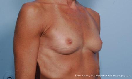 Philadelphia Breast Augmentation 8656 - Before Image 2