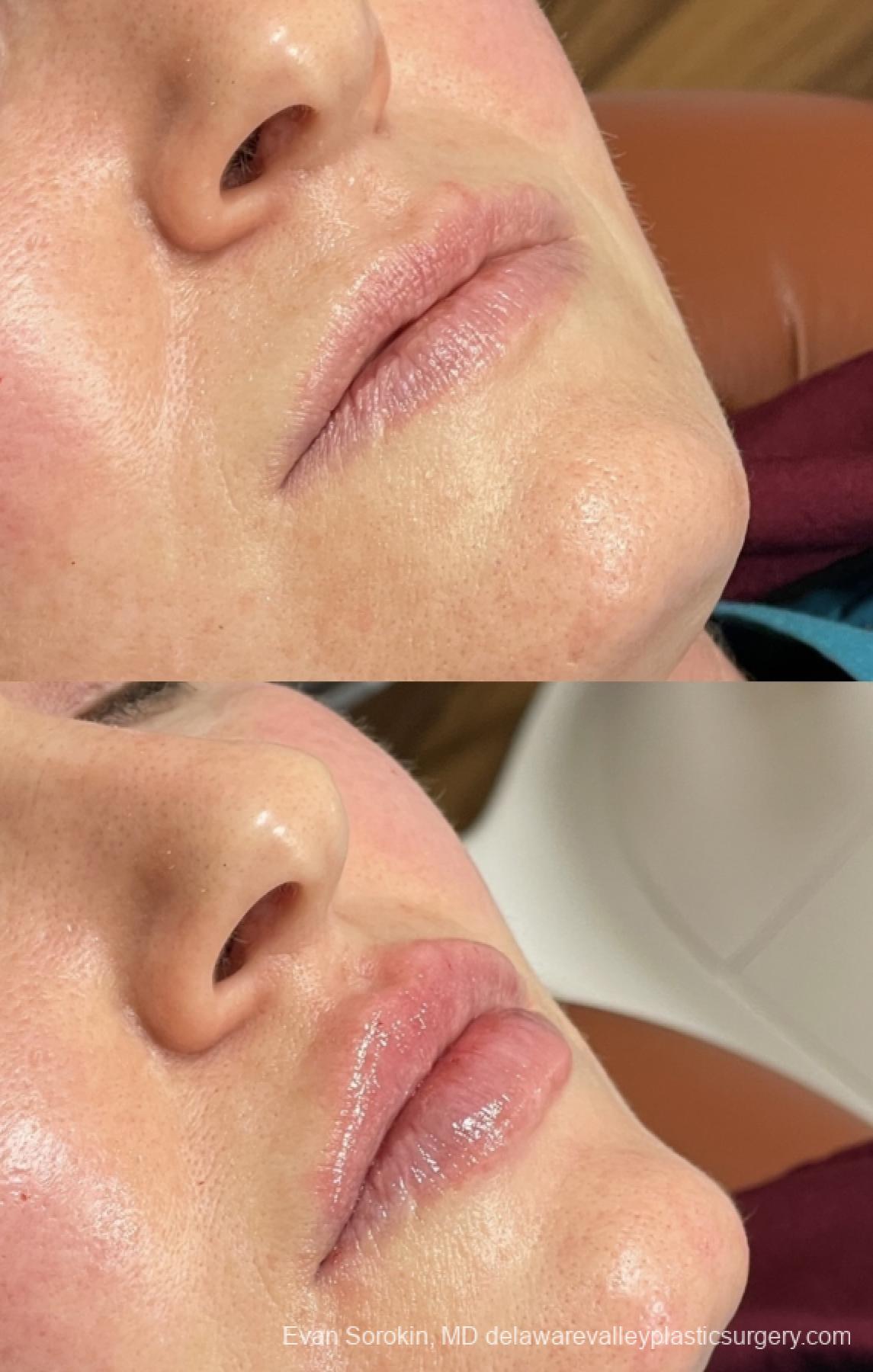 Lip Augmentation: Patient 46 - Before and After 2