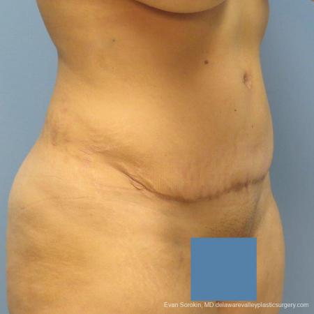 Philadelphia Abdominoplasty 9478 - After Image 4
