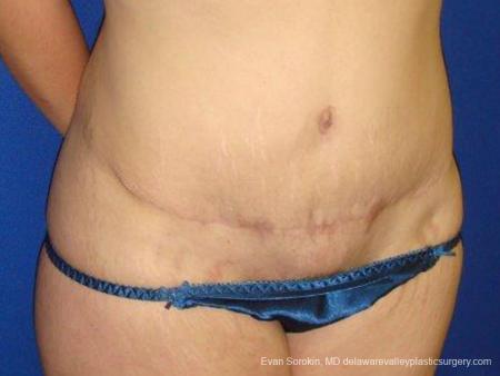 Philadelphia Abdominoplasty 9473 - After Image 2