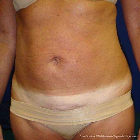 Philadelphia Liposuction 9488 - After Image 2