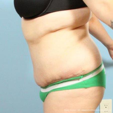 Philadelphia Abdominoplasty 9466 - After Image 4
