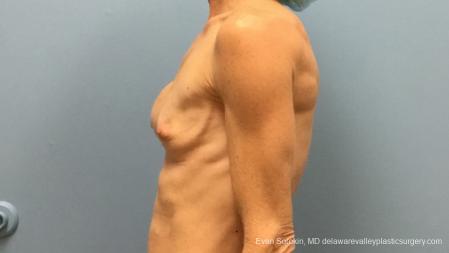 Philadelphia Breast Augmentation 13182 - Before Image 3