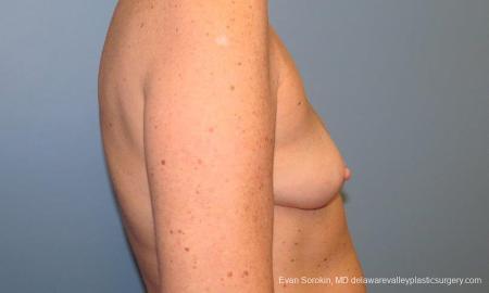 Philadelphia Breast Augmentation 9549 - Before Image 3