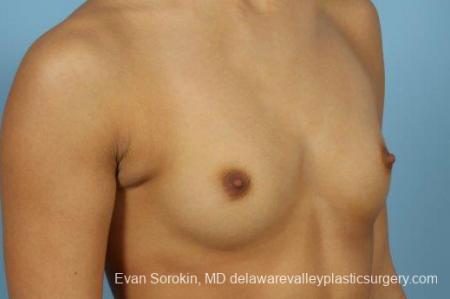 Philadelphia Breast Augmentation 9408 - Before Image 2