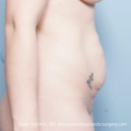 Philadelphia Abdominoplasty 8681 - Before Image 4