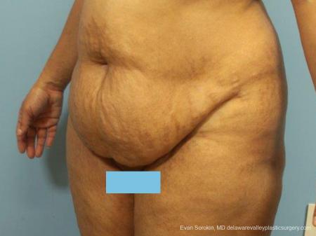 Philadelphia Abdominoplasty 9462 - Before Image 4