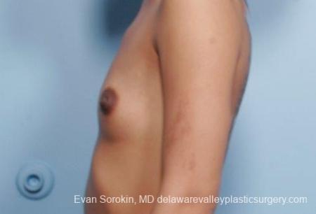 Philadelphia Breast Augmentation 9106 - Before and After Image 5