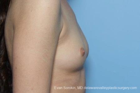 Philadelphia Breast Augmentation 8771 - Before Image 4