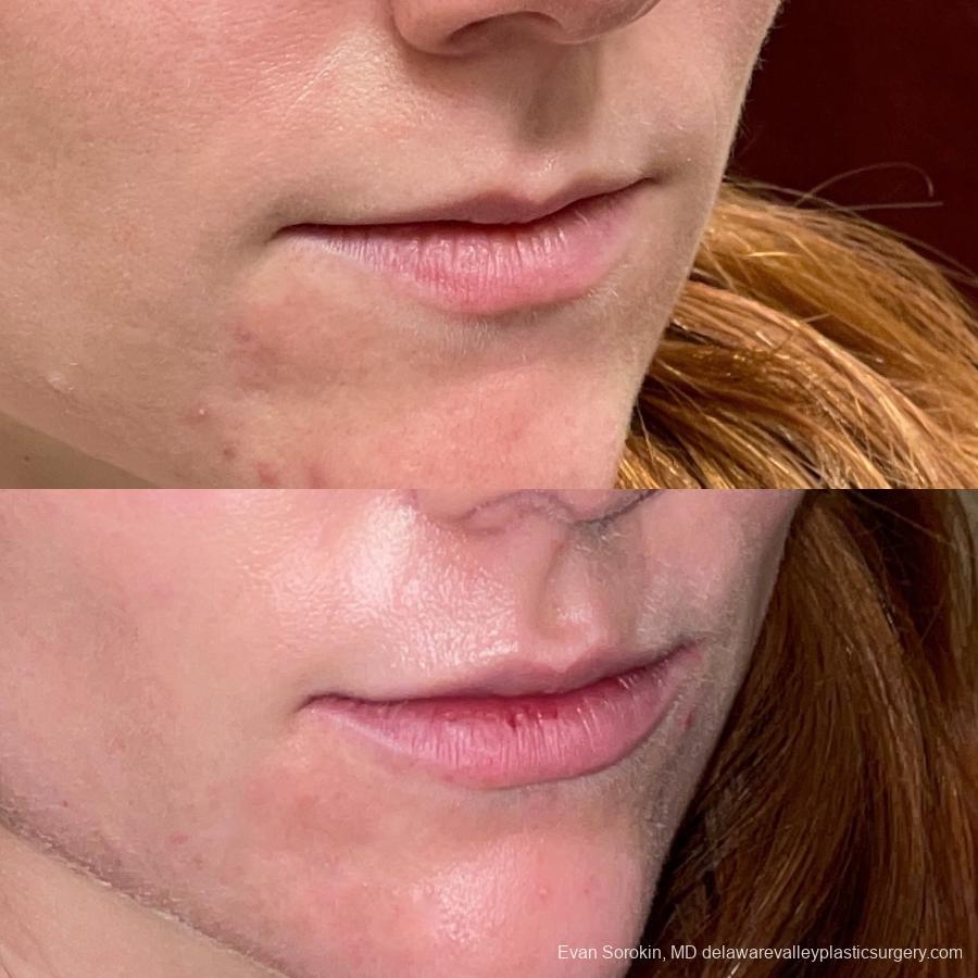 Lip Filler: Patient 31 - Before and After 2