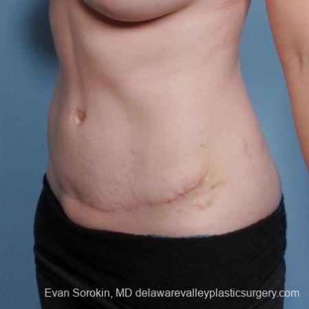 Philadelphia Abdominoplasty 8681 - After Image 3