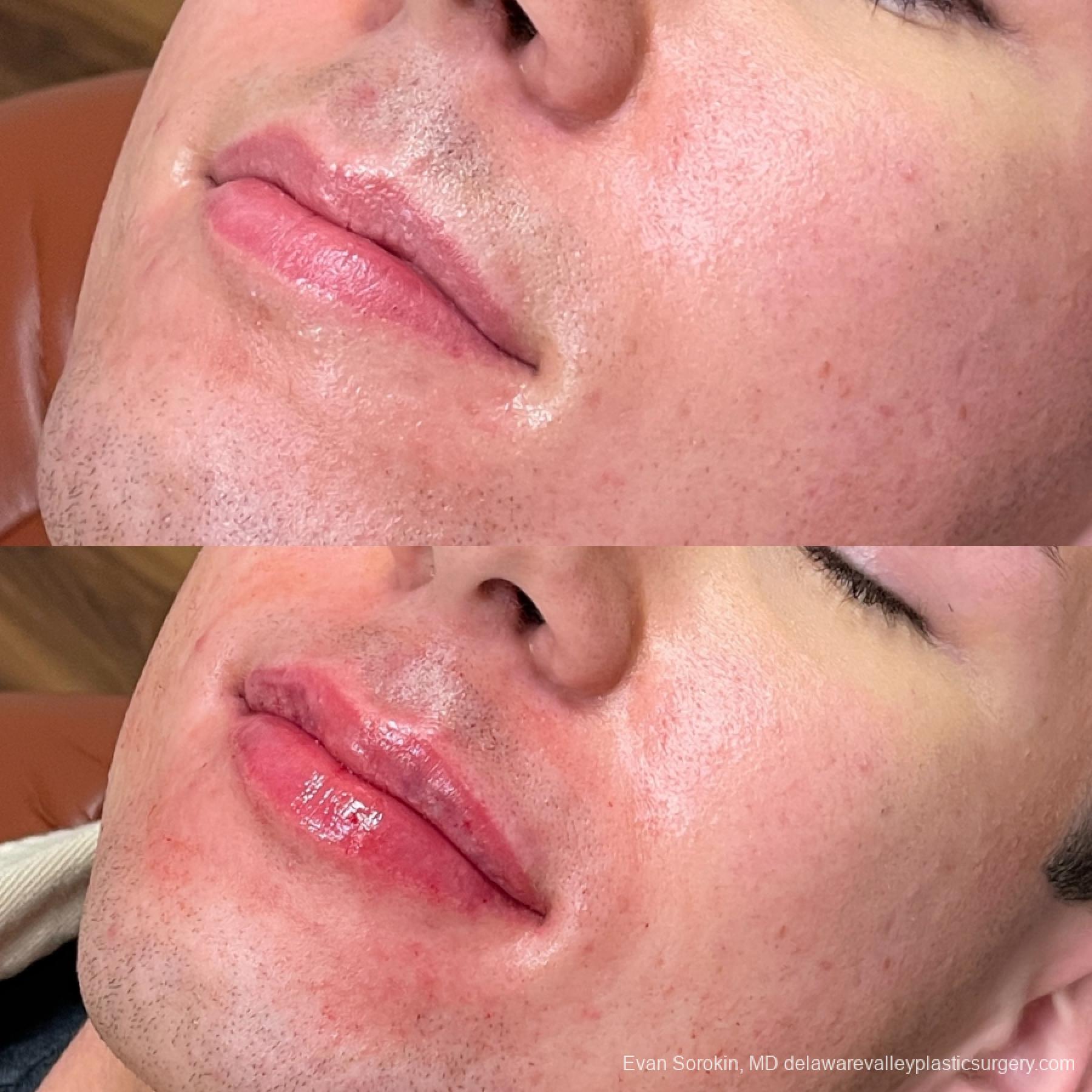 Lip Filler: Patient 52 - Before and After 3