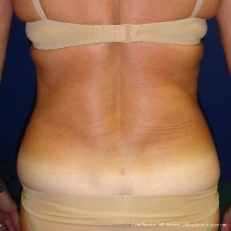 Philadelphia Liposuction 9488 - After Image 5