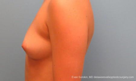 Philadelphia Breast Augmentation 9386 - Before and After Image 5