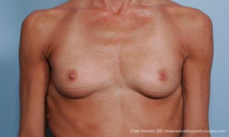 Philadelphia Breast Augmentation 8656 - Before Image 1