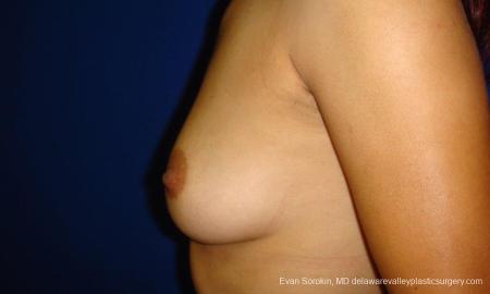 Philadelphia Breast Augmentation 9294 - Before Image 3