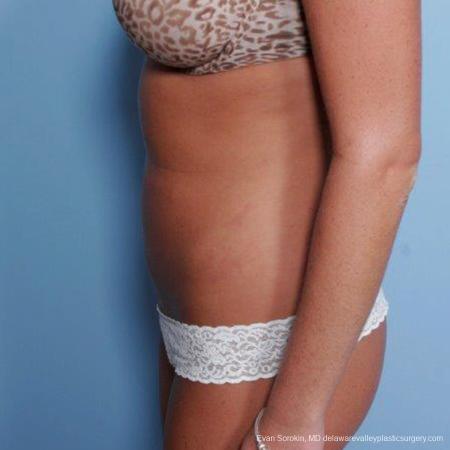 Philadelphia Liposuction 9483 - After Image 3