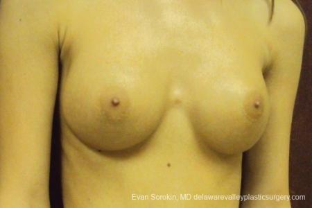 Philadelphia Breast Augmentation 8668 - After Image 2