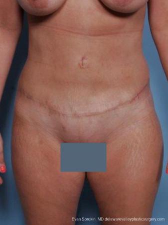 Philadelphia Abdominoplasty 9460 - After Image 1
